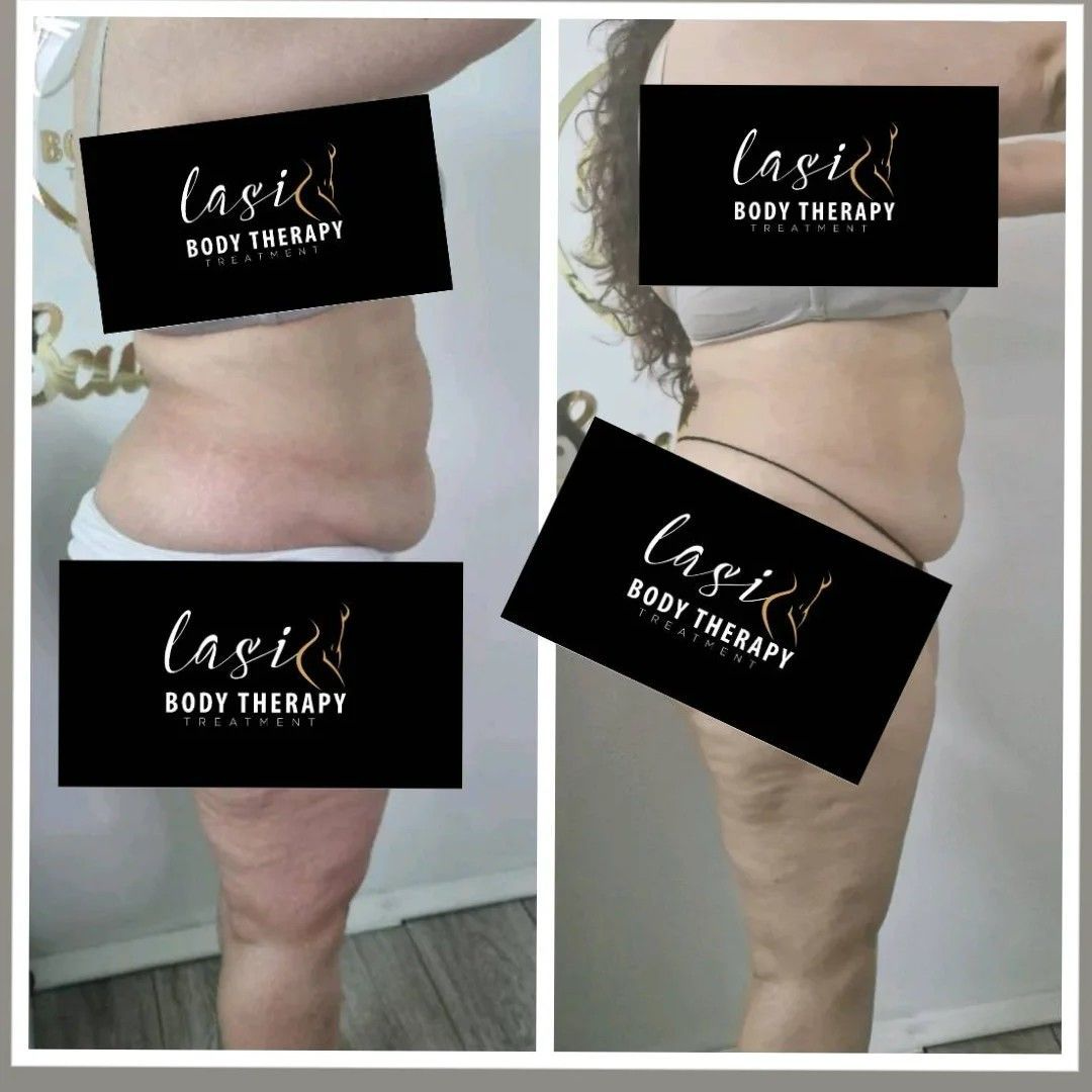lipo-cavitation treatment result